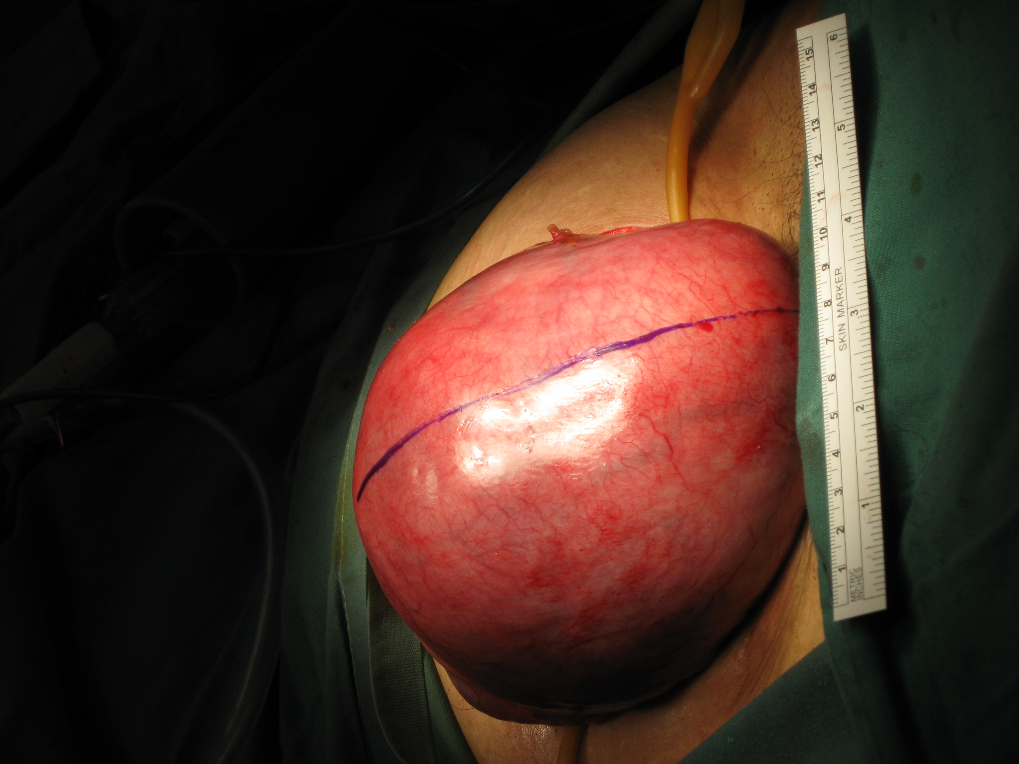 Myomectomy Fibroid Abdominal Serag Youssif (6)